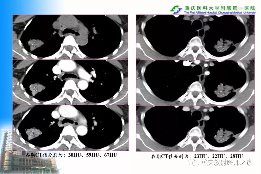 影像PPT - 【PPT】碘对比剂CT增强的影响因素与临床应用-51