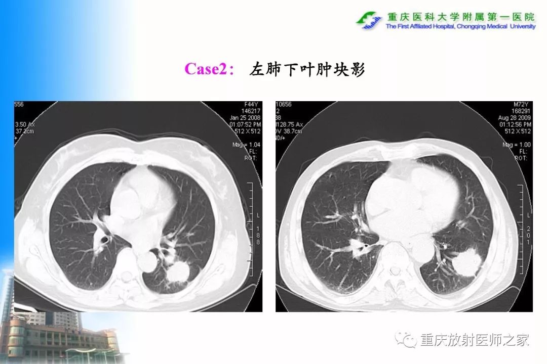 影像PPT - 【PPT】碘对比剂CT增强的影响因素与临床应用-52