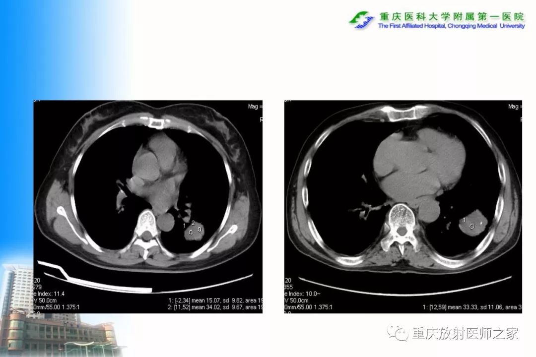 影像PPT - 【PPT】碘对比剂CT增强的影响因素与临床应用-53