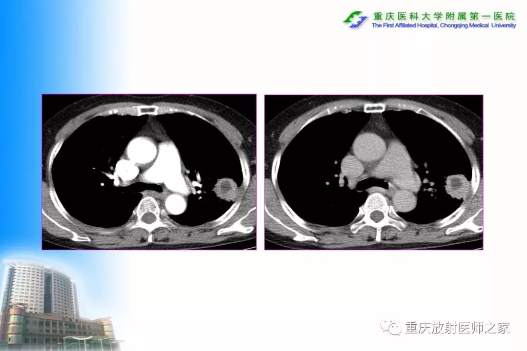 影像PPT - 【PPT】碘对比剂CT增强的影响因素与临床应用-56