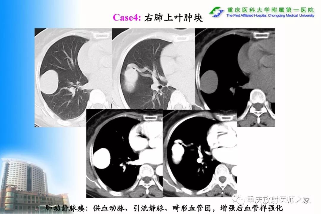 影像PPT - 【PPT】碘对比剂CT增强的影响因素与临床应用-57