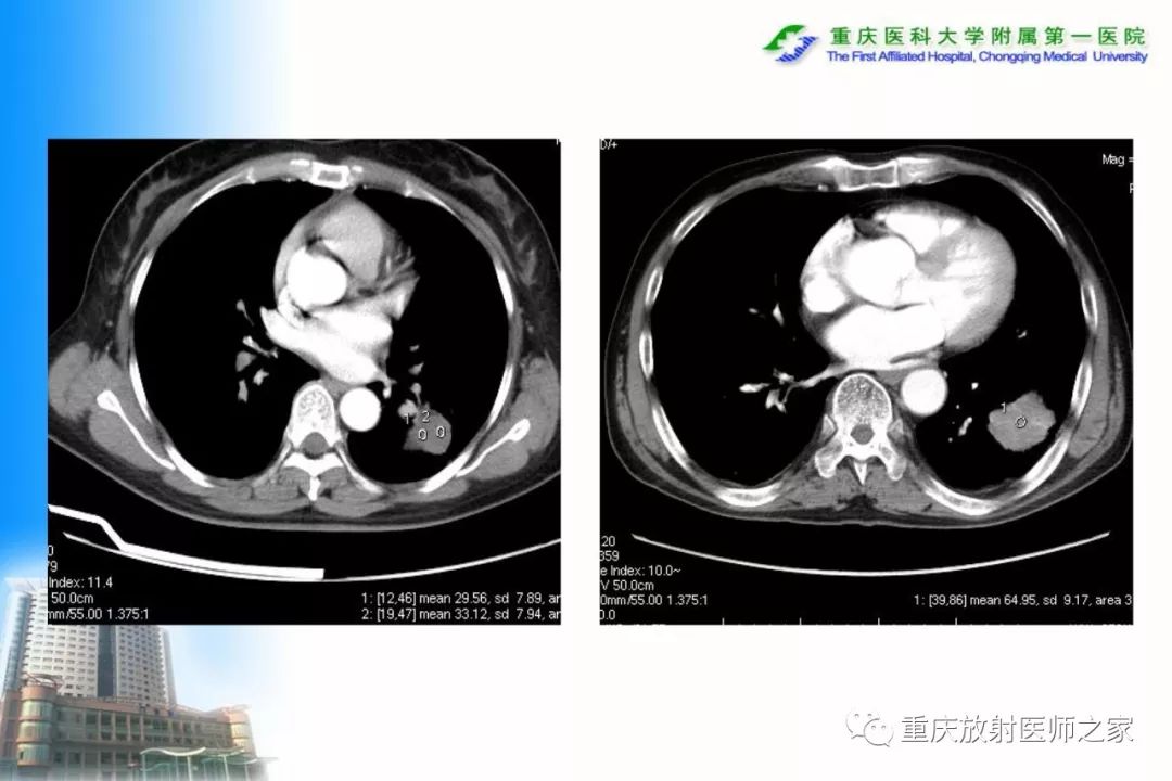 影像PPT - 【PPT】碘对比剂CT增强的影响因素与临床应用-54