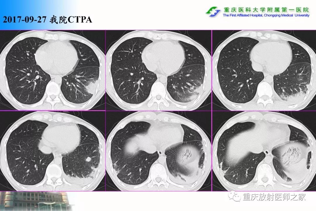 影像PPT - 【PPT】碘对比剂CT增强的影响因素与临床应用-63