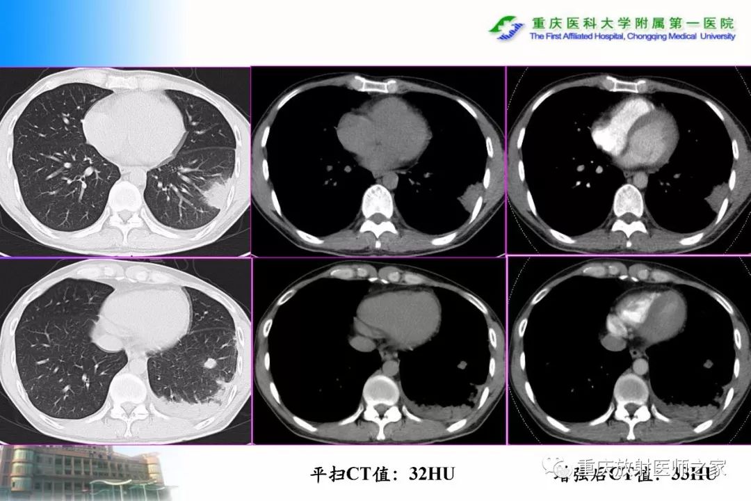 影像PPT - 【PPT】碘对比剂CT增强的影响因素与临床应用-64