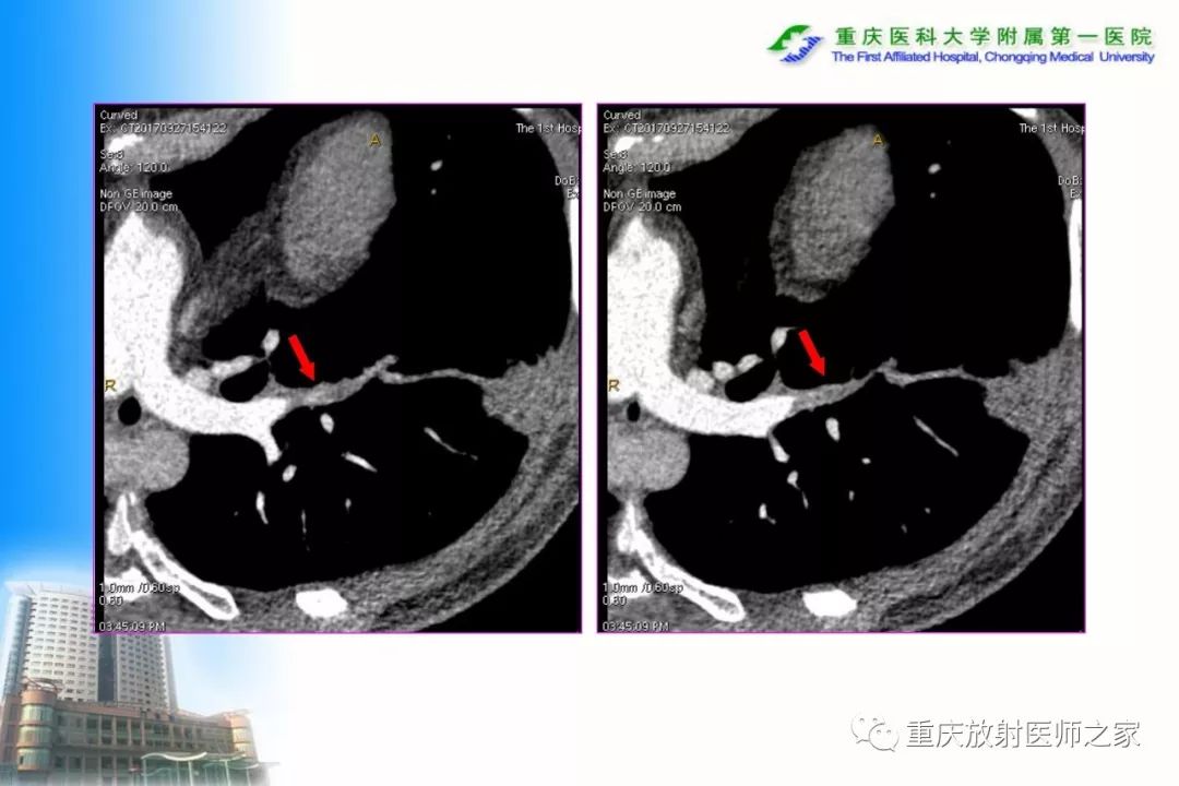 影像PPT - 【PPT】碘对比剂CT增强的影响因素与临床应用-66
