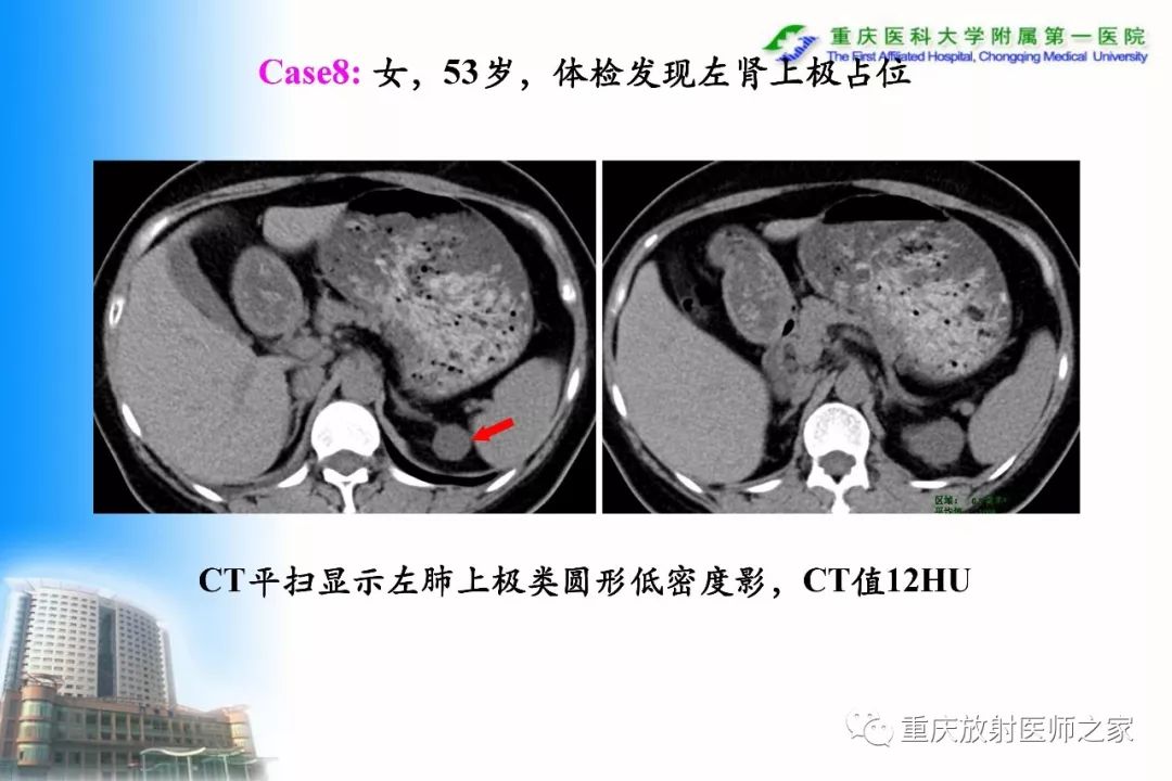 影像PPT - 【PPT】碘对比剂CT增强的影响因素与临床应用-70