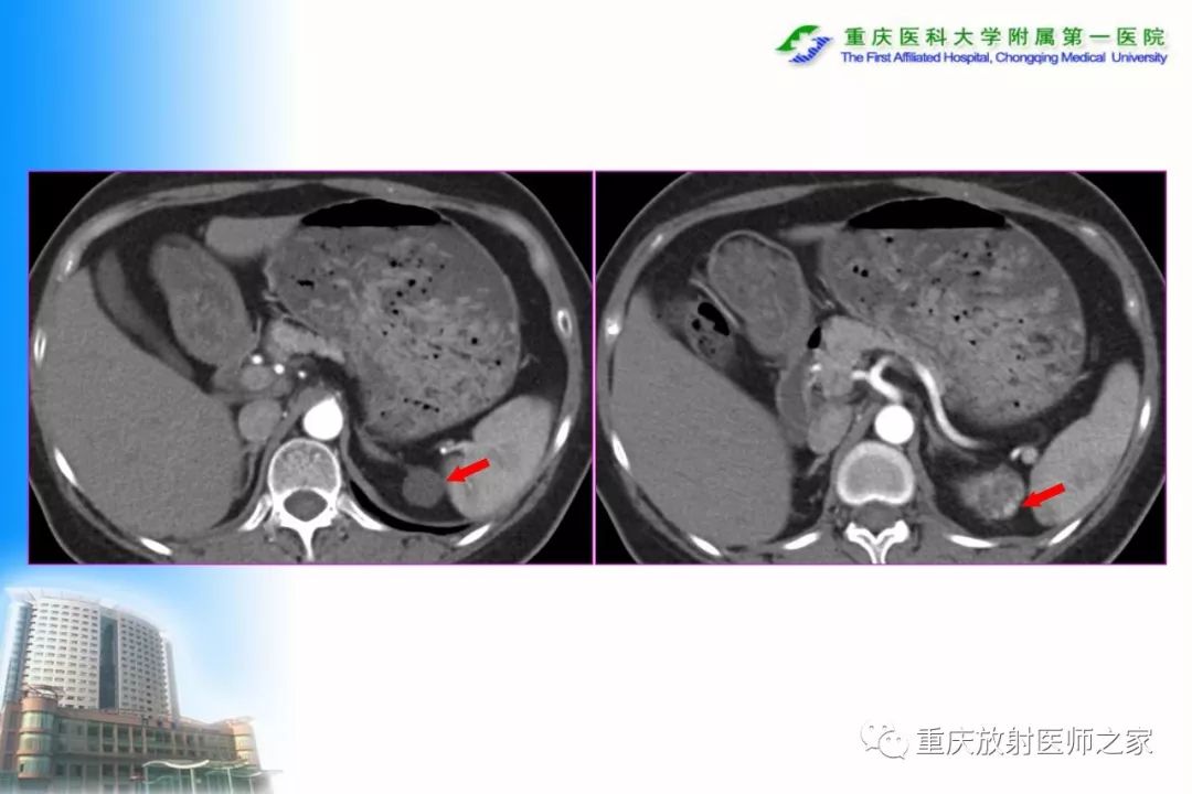 影像PPT - 【PPT】碘对比剂CT增强的影响因素与临床应用-71