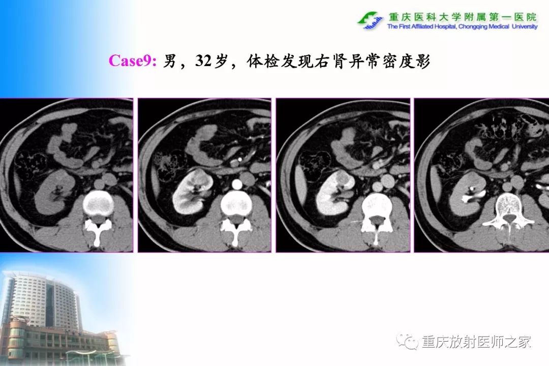影像PPT - 【PPT】碘对比剂CT增强的影响因素与临床应用-73