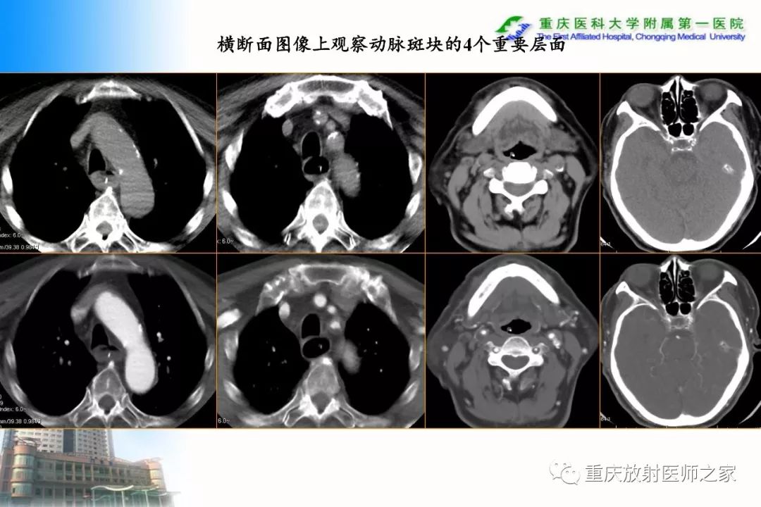 影像PPT - 【PPT】碘对比剂CT增强的影响因素与临床应用-81