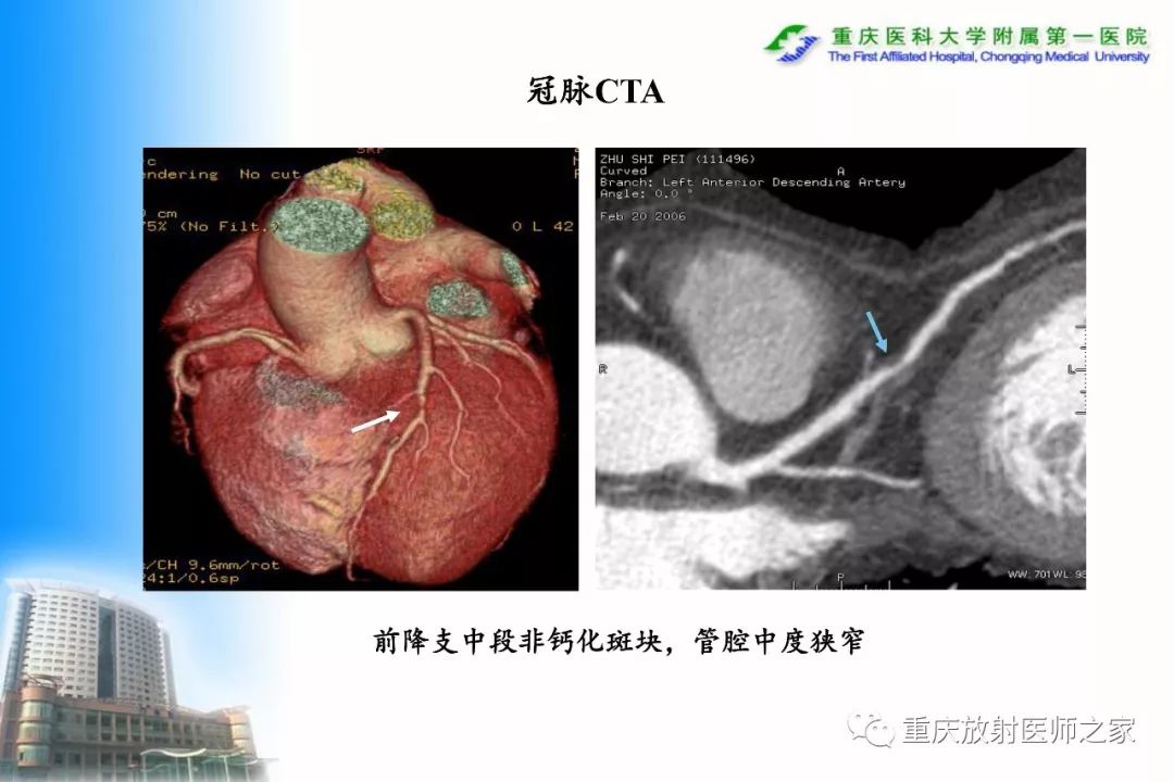 影像PPT - 【PPT】碘对比剂CT增强的影响因素与临床应用-83