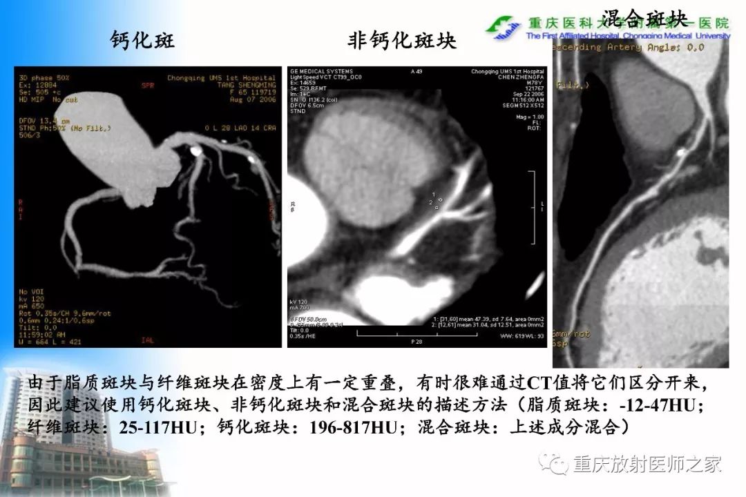 影像PPT - 【PPT】碘对比剂CT增强的影响因素与临床应用-84