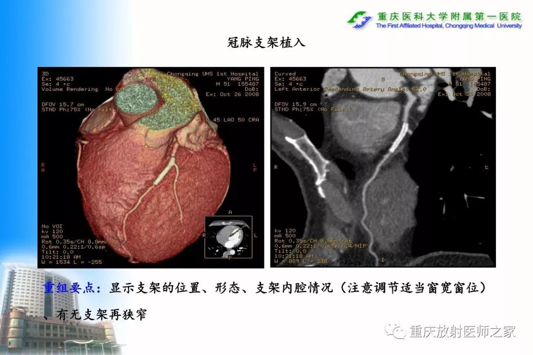影像PPT - 【PPT】碘对比剂CT增强的影响因素与临床应用-85
