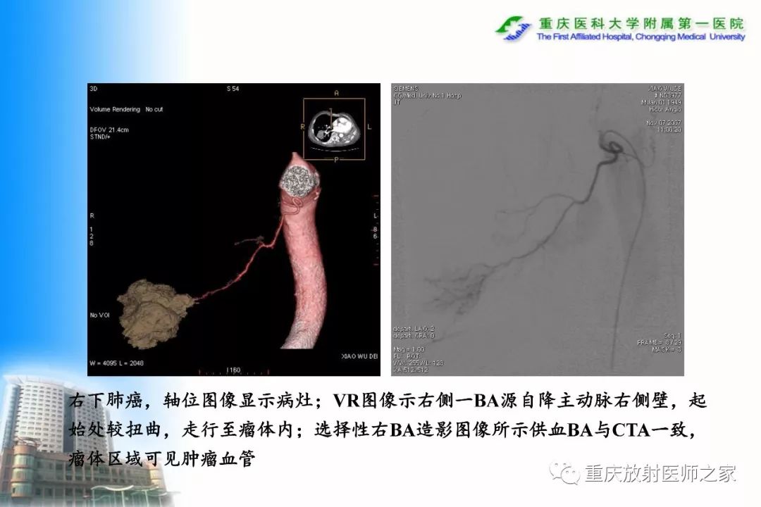 影像PPT - 【PPT】碘对比剂CT增强的影响因素与临床应用-87