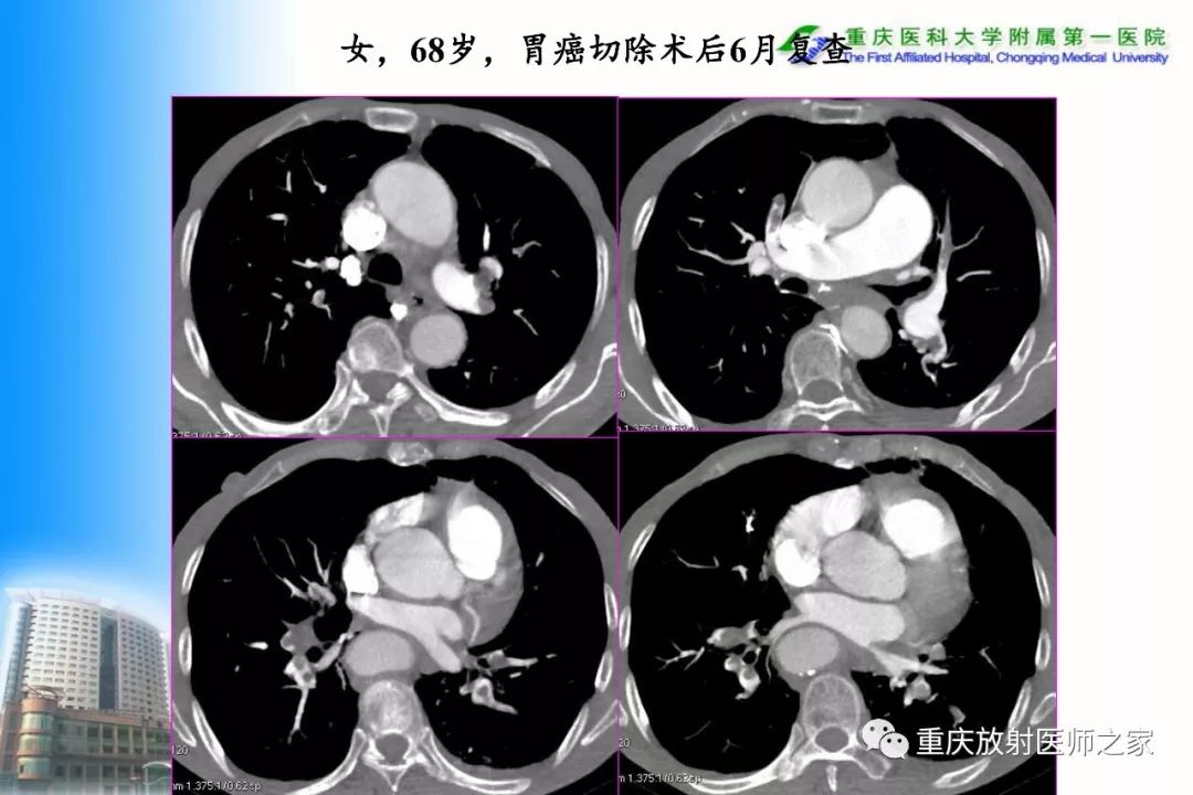 影像PPT - 【PPT】碘对比剂CT增强的影响因素与临床应用-96