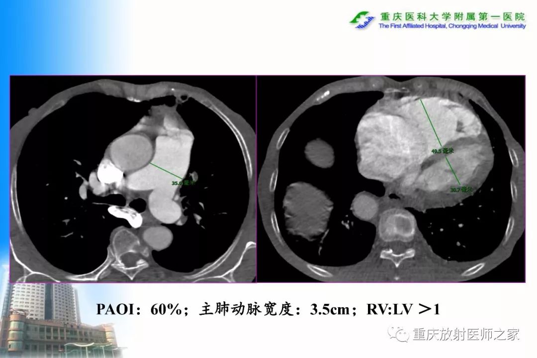 影像PPT - 【PPT】碘对比剂CT增强的影响因素与临床应用-97