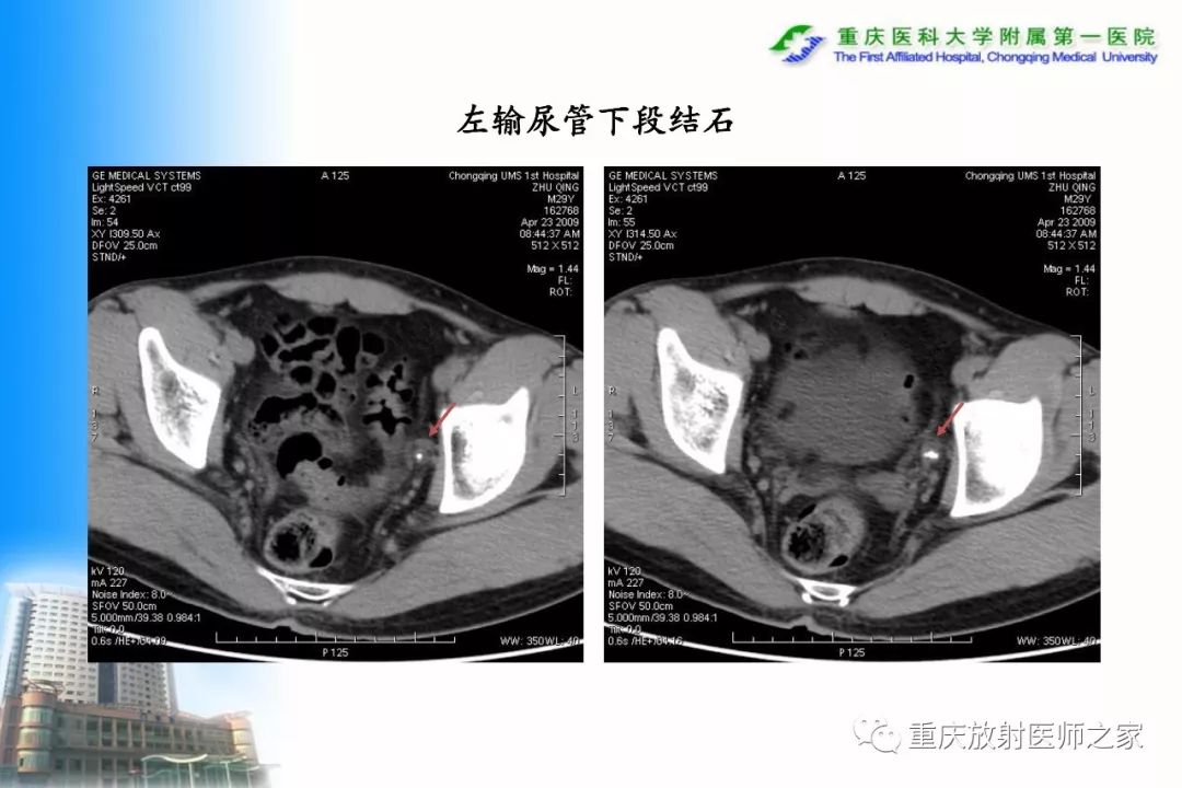 影像PPT - 【PPT】碘对比剂CT增强的影响因素与临床应用-108