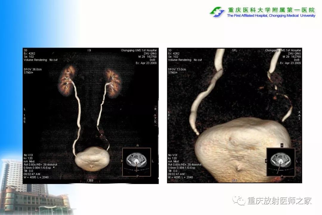 影像PPT - 【PPT】碘对比剂CT增强的影响因素与临床应用-109