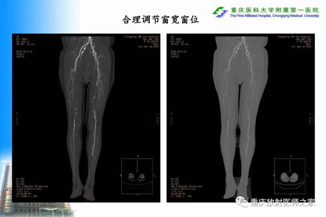 影像PPT - 【PPT】碘对比剂CT增强的影响因素与临床应用-117
