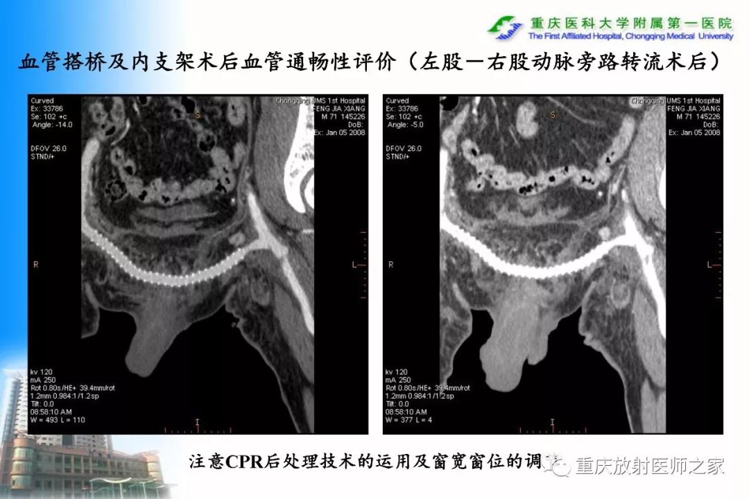 影像PPT - 【PPT】碘对比剂CT增强的影响因素与临床应用-119