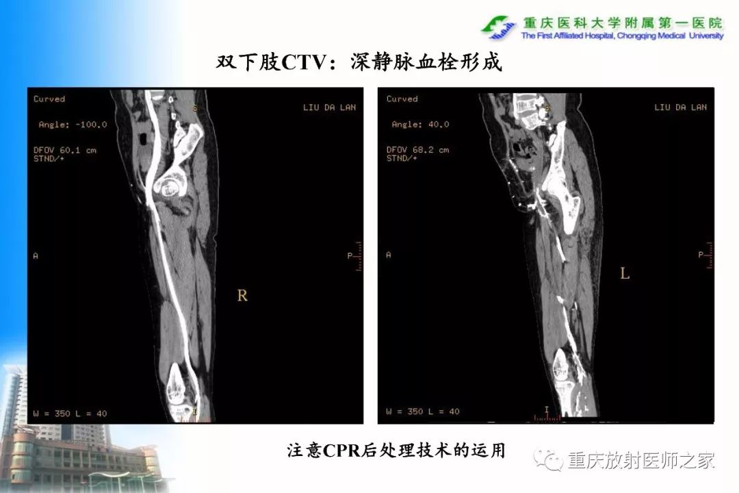 影像PPT - 【PPT】碘对比剂CT增强的影响因素与临床应用-120