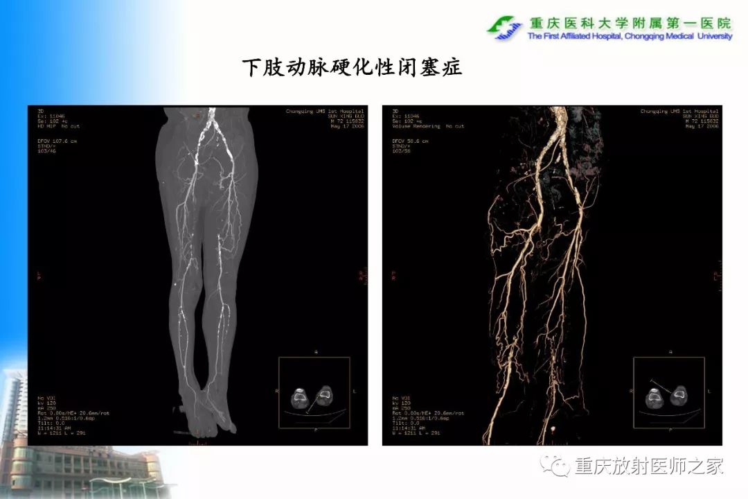 影像PPT - 【PPT】碘对比剂CT增强的影响因素与临床应用-116