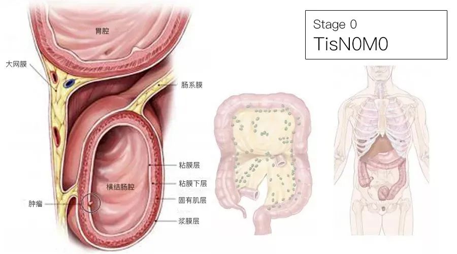 影像PPT - 结直肠癌分期-2 影像PPT - 结直肠癌分期-2