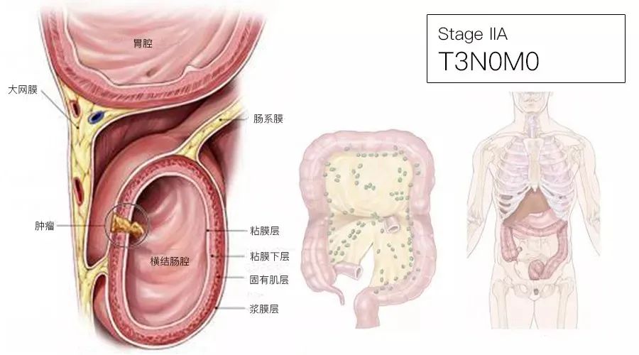 影像PPT - 结直肠癌分期-4 影像PPT - 结直肠癌分期-4