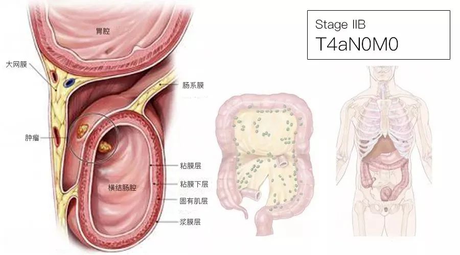 影像PPT - 结直肠癌分期-5 影像PPT - 结直肠癌分期-5