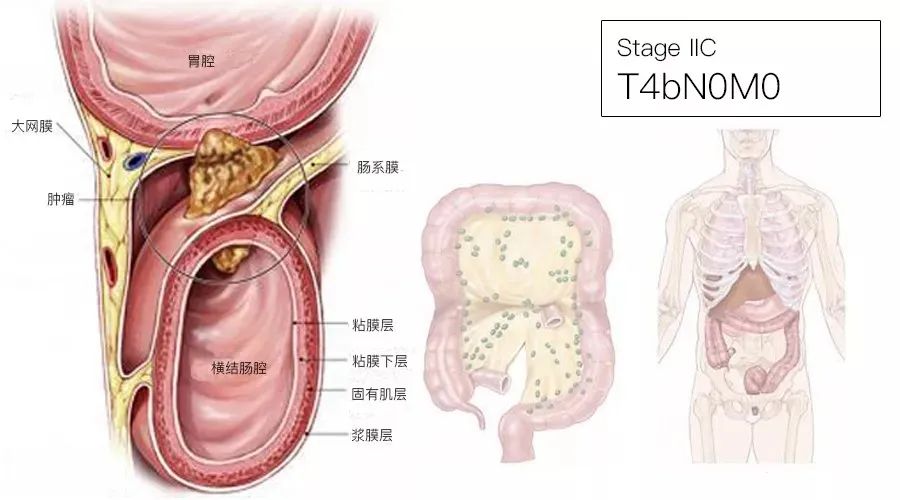 影像PPT - 结直肠癌分期-6 影像PPT - 结直肠癌分期-6