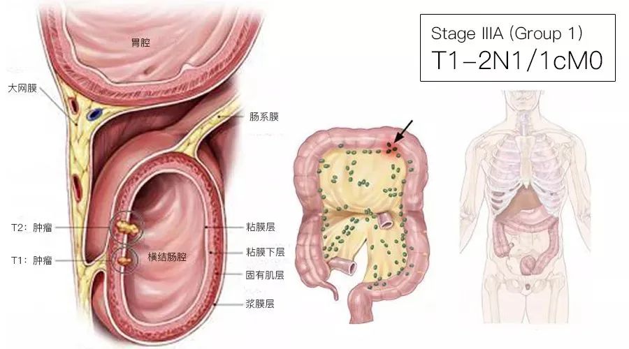 影像PPT - 结直肠癌分期-7 影像PPT - 结直肠癌分期-7