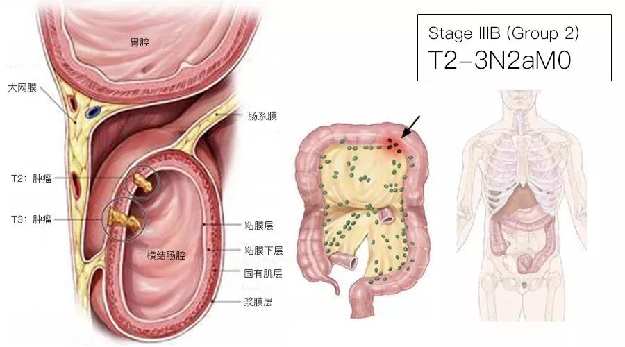 影像PPT - 结直肠癌分期-10 影像PPT - 结直肠癌分期-10