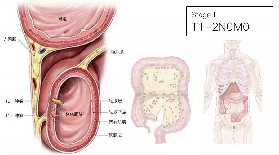 影像PPT - 结直肠癌分期-3 影像PPT - 结直肠癌分期-3