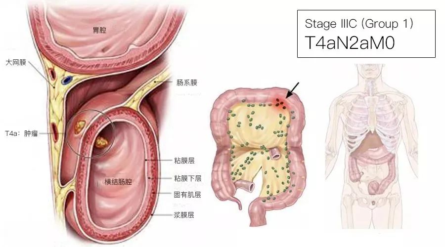 影像PPT - 结直肠癌分期-12 影像PPT - 结直肠癌分期-12