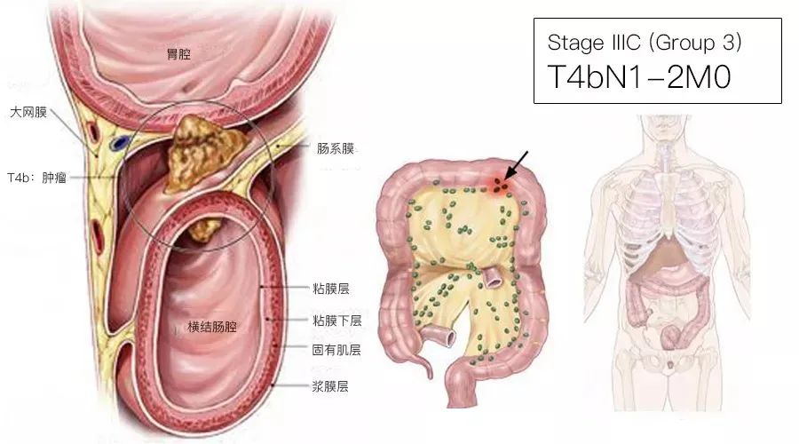 影像PPT - 结直肠癌分期-14 影像PPT - 结直肠癌分期-14