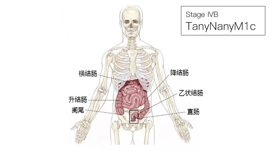 影像PPT - 结直肠癌分期-17 影像PPT - 结直肠癌分期-17