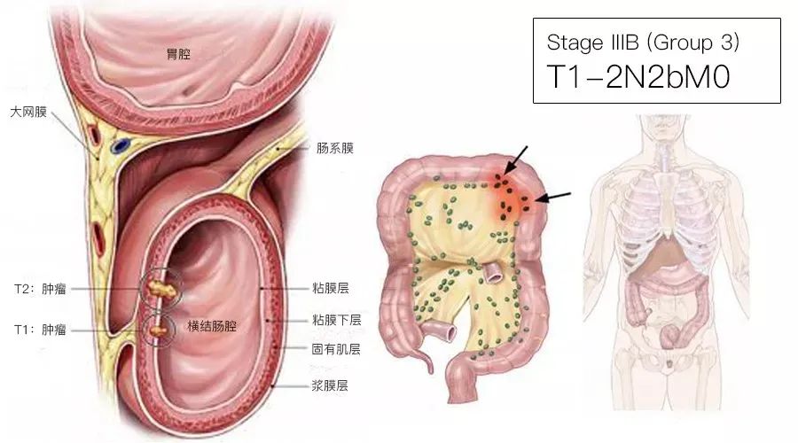影像PPT - 结直肠癌分期-11 影像PPT - 结直肠癌分期-11