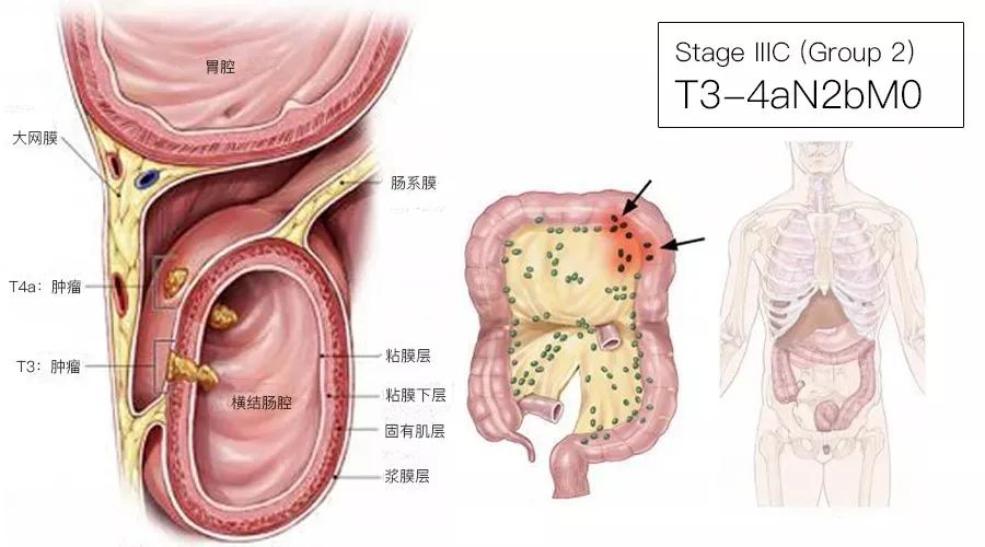 影像PPT - 结直肠癌分期-13 影像PPT - 结直肠癌分期-13