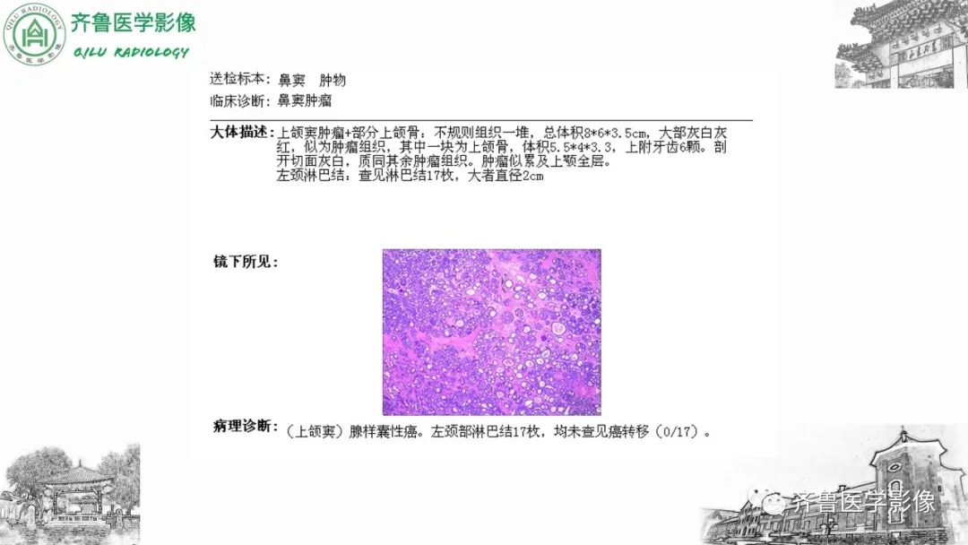 影像PPT - 【病例】上颌窦腺样囊性癌2例CT及MR影像鉴别-8