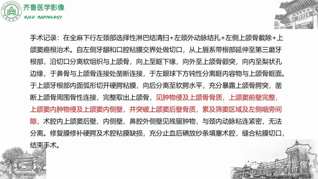 影像PPT - 【病例】上颌窦腺样囊性癌2例CT及MR影像鉴别-9