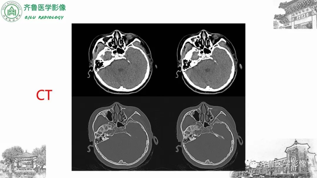 影像PPT - 【病例】上颌窦腺样囊性癌2例CT及MR影像鉴别-14