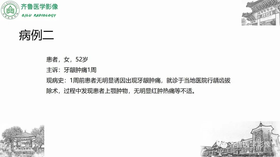 影像PPT - 【病例】上颌窦腺样囊性癌2例CT及MR影像鉴别-10