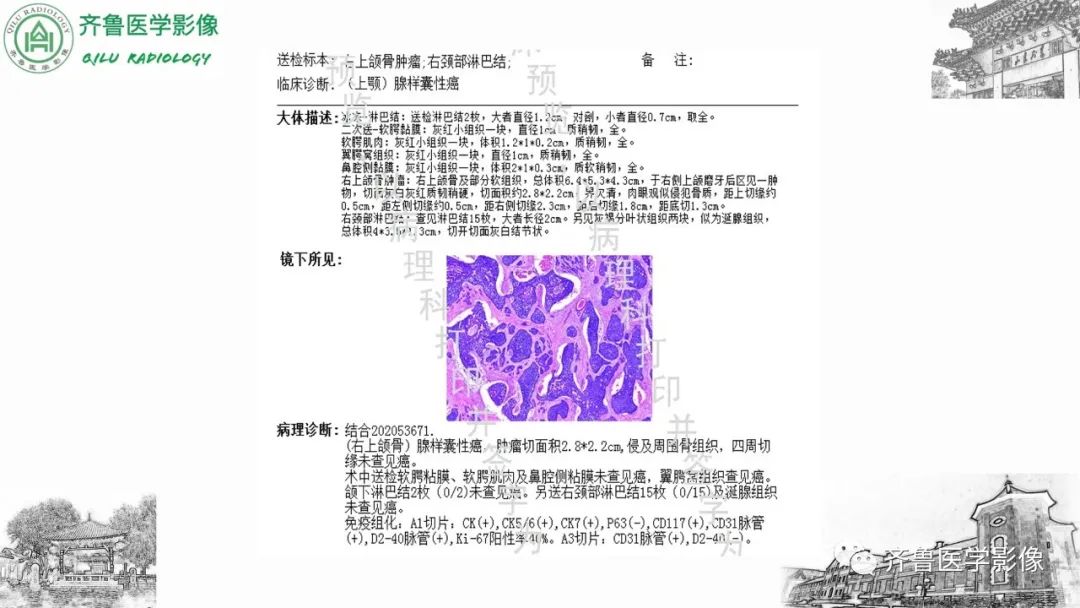 影像PPT - 【病例】上颌窦腺样囊性癌2例CT及MR影像鉴别-15
