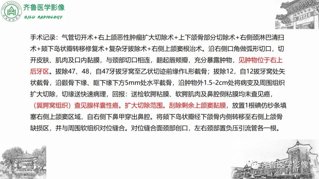 影像PPT - 【病例】上颌窦腺样囊性癌2例CT及MR影像鉴别-16
