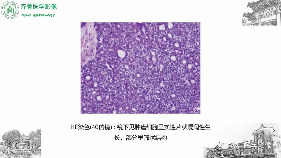 影像PPT - 【病例】上颌窦腺样囊性癌2例CT及MR影像鉴别-20
