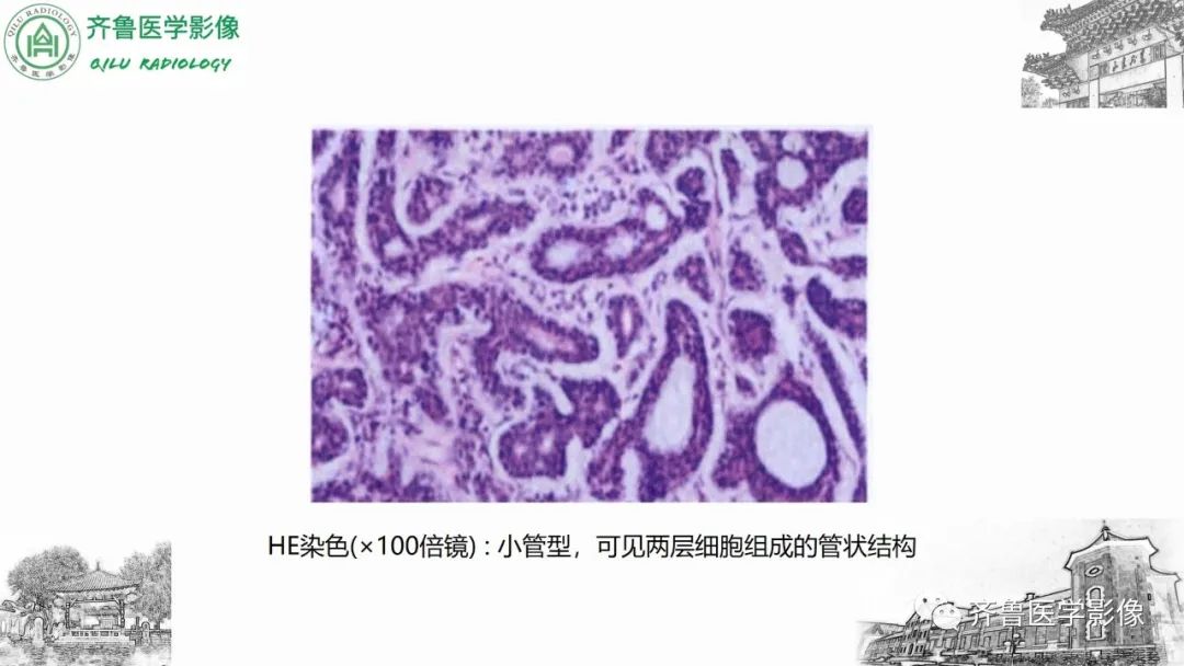 影像PPT - 【病例】上颌窦腺样囊性癌2例CT及MR影像鉴别-21