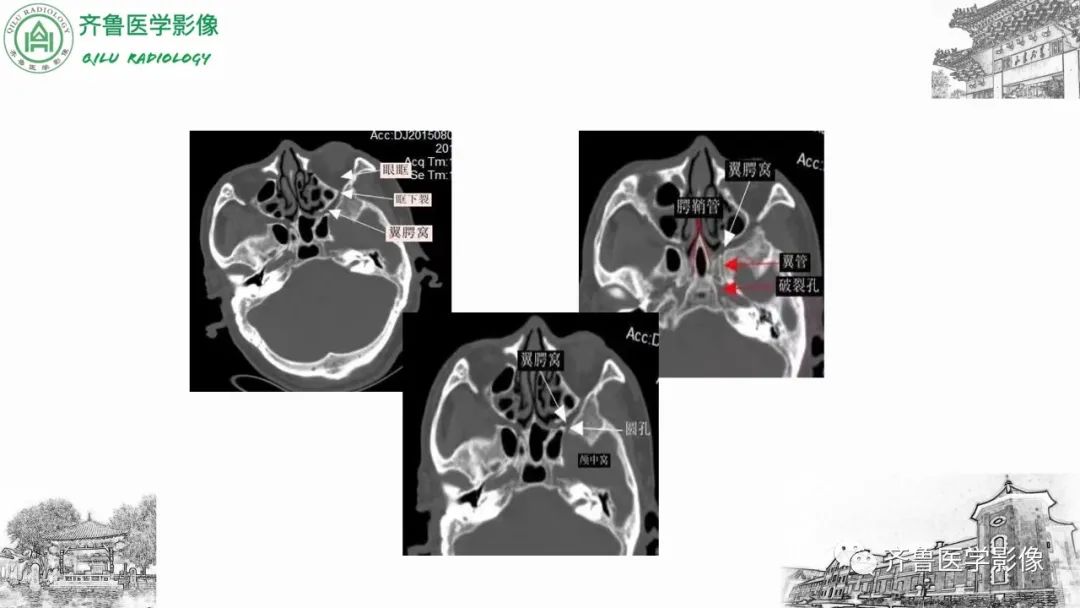影像PPT - 【病例】上颌窦腺样囊性癌2例CT及MR影像鉴别-24