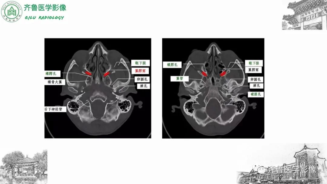 影像PPT - 【病例】上颌窦腺样囊性癌2例CT及MR影像鉴别-25
