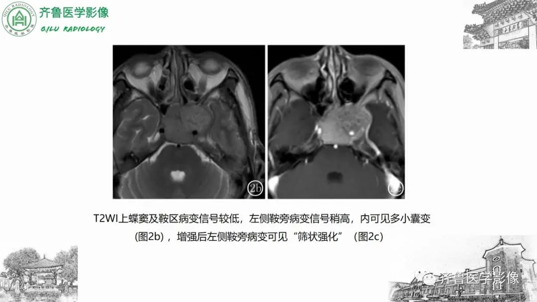 影像PPT - 【病例】上颌窦腺样囊性癌2例CT及MR影像鉴别-27