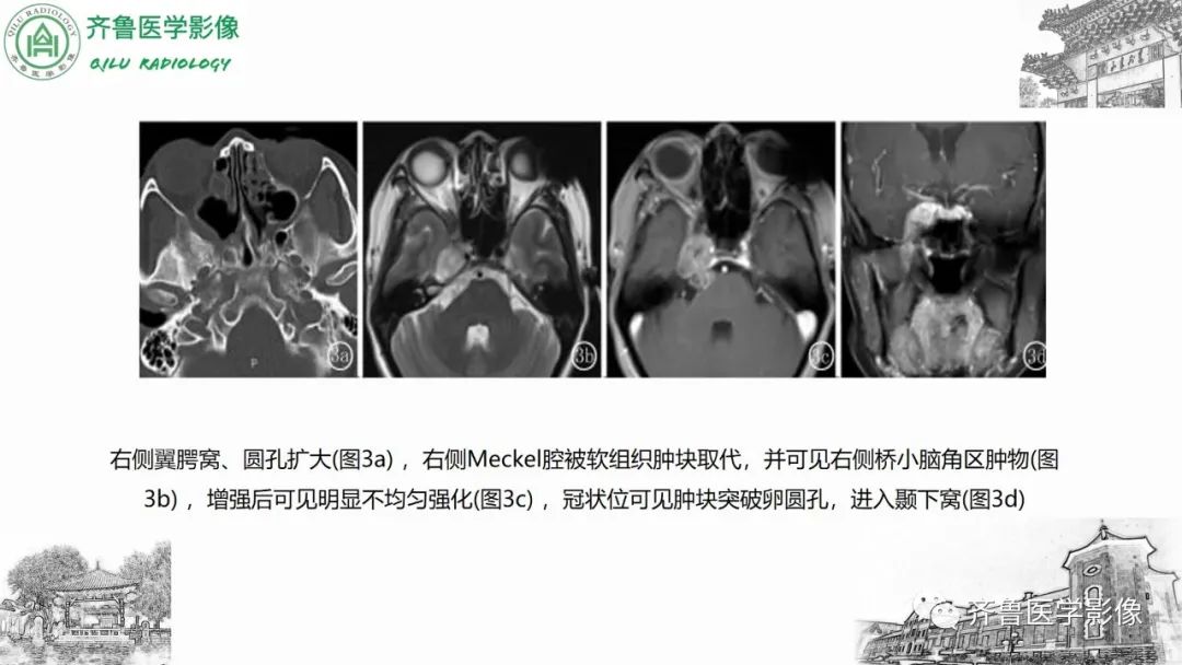 影像PPT - 【病例】上颌窦腺样囊性癌2例CT及MR影像鉴别-28