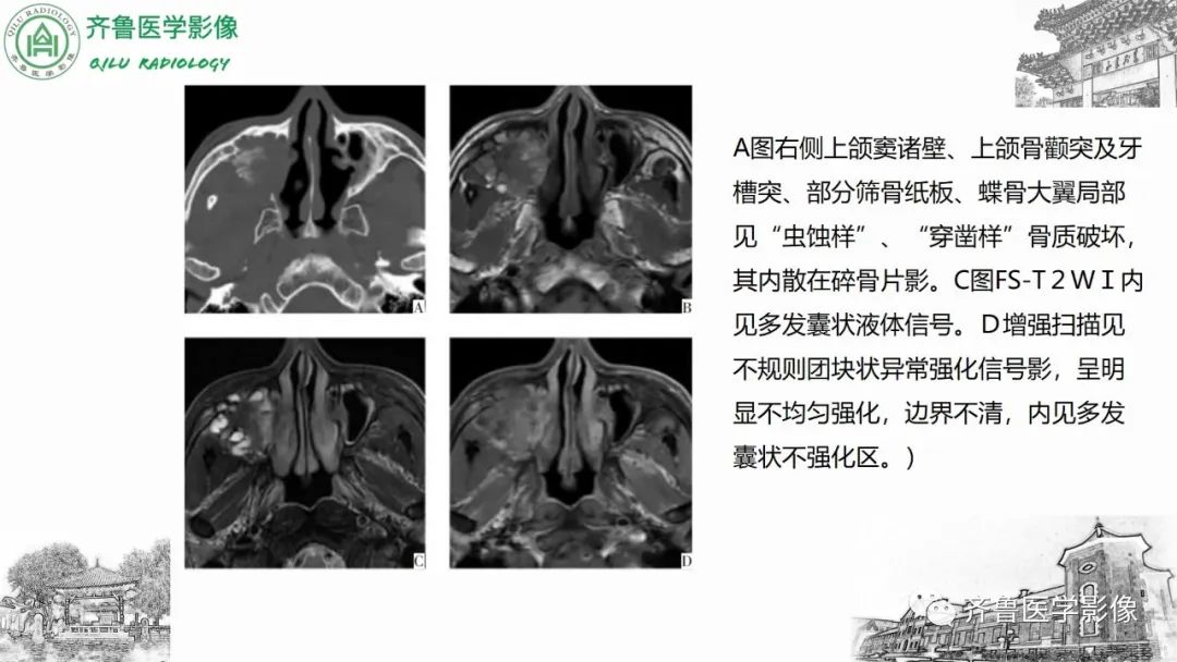 影像PPT - 【病例】上颌窦腺样囊性癌2例CT及MR影像鉴别-29